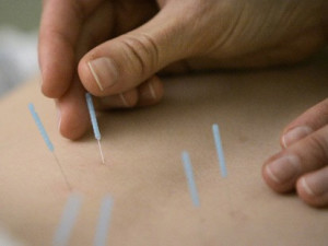 Acupuncture Treatments picture