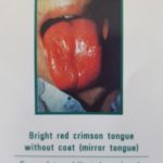 Picture of a bright red crimson tongue without coat (mirror tongue), symptom of severe internal heat damaging the Yin, Yin deficiency