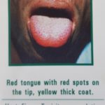 Picture of a red tongue with red spots on the tip, yellow thick coat symptom of heat, fire or toxicity accumulation